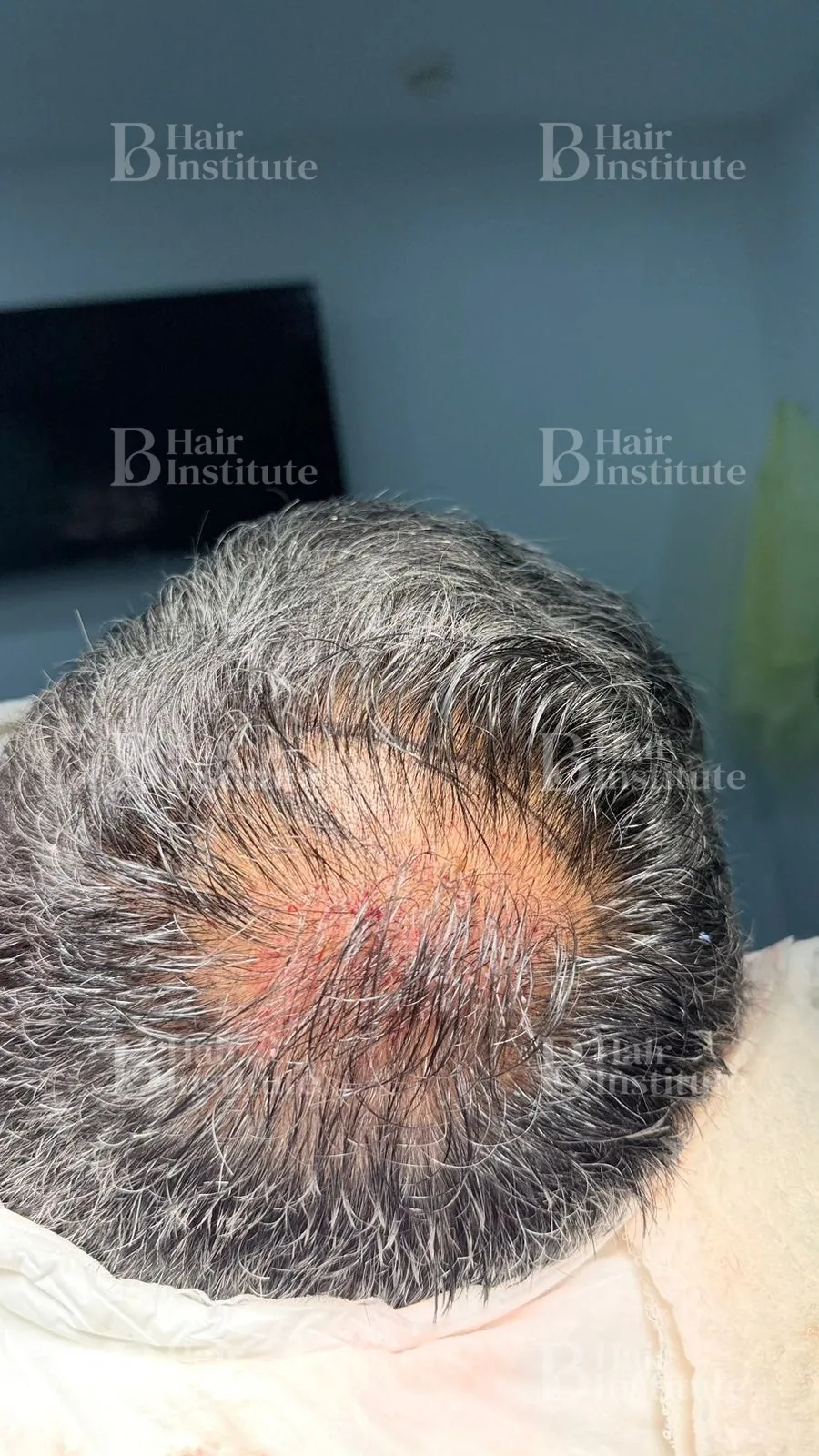 Coronilla con pérdida de densidad antes de una cirugía FUE Long Hair