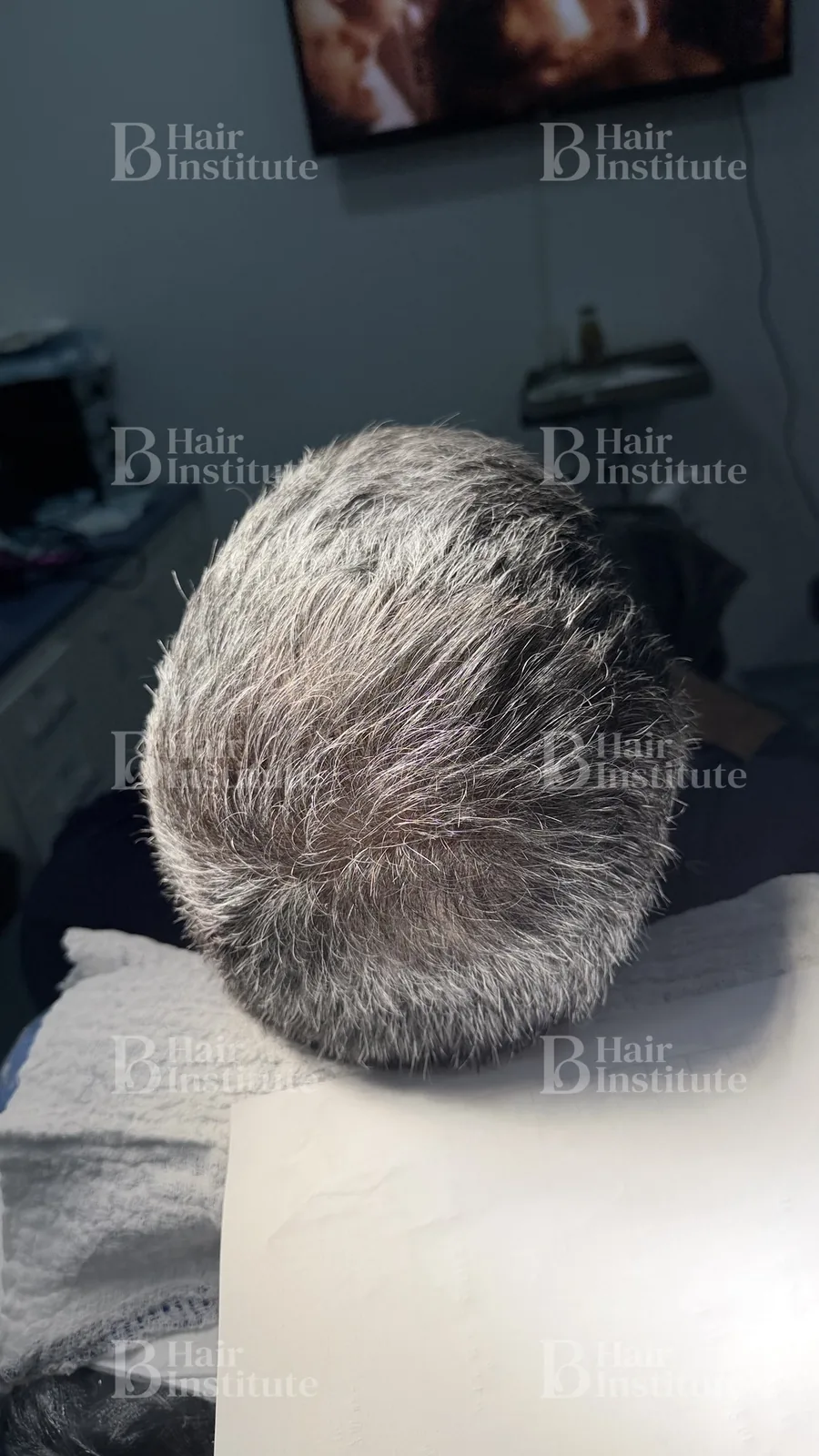 La misma coronilla tras la cirugía FUE Long Hair, con densidad recuperada