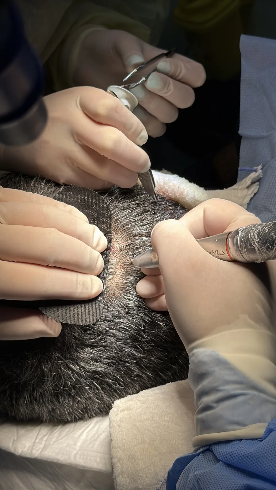 Extracción folicular entre cabello largo con punch de FUE Long Hair, sin rapar la zona donante