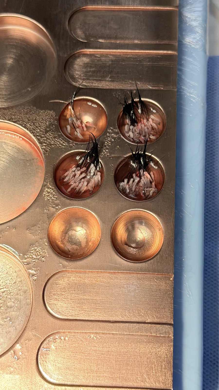 Unidades foliculares con el cabello largo intacto, conservadas en una placa refrigerada durante una cirugía FUE Long Hair