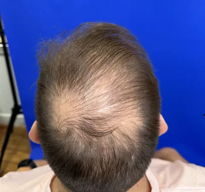 Antes de tratamiento capilar con PRP y mesoterapia en paciente de 47 años con caída del cabello