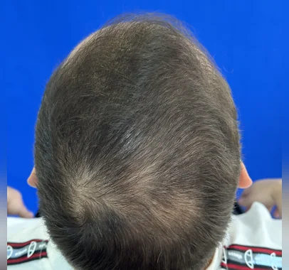 Resultado de PRP capilar y mesoterapia en 3 sesiones con pauta oral complementaria