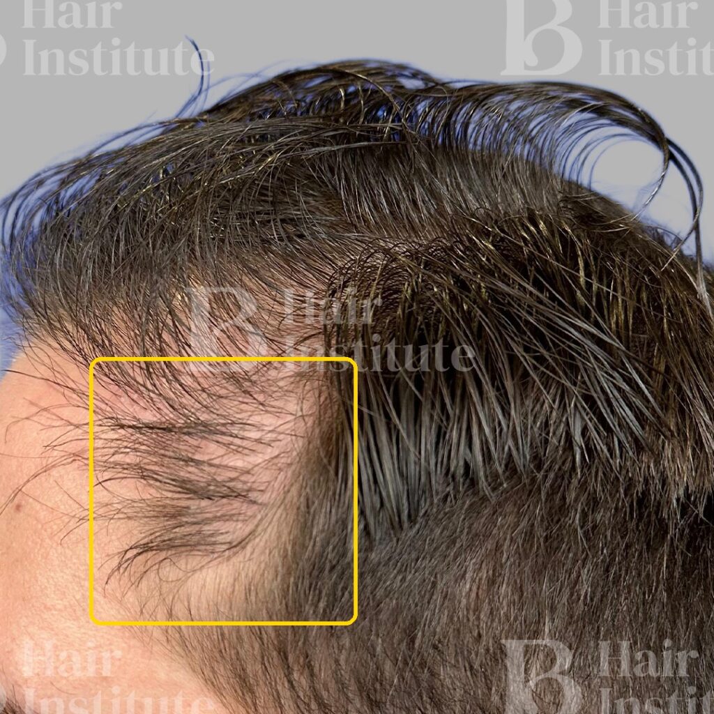 Línea de implantación de un implante previo con pelo creciendo en dirección anómala por un ángulo incorrecto; la zona del problema aparece marcada
